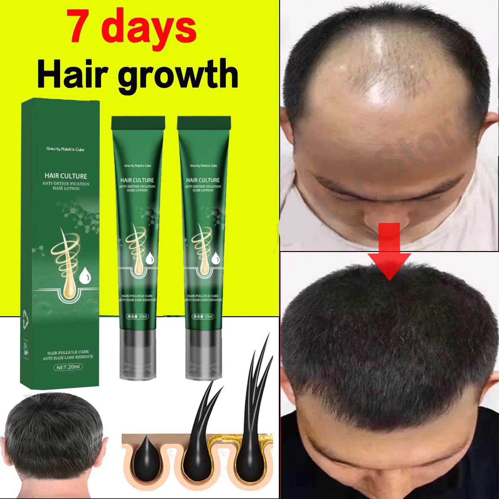 Óleo de crescimento padaryti cabelo rápido crescimento padaryti cabelo eficaz calvície reparação hereditária perda de cabelo pós-parto 